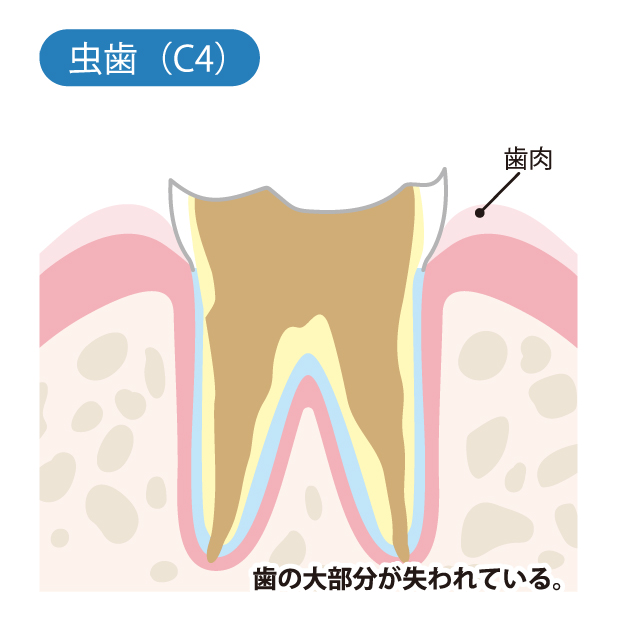 飯田橋の歯医者、飯田橋サンシャイン歯科でむし歯治療