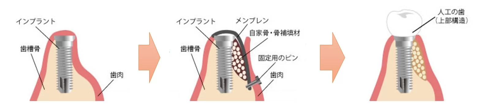 飯田橋の歯医者、飯田橋サンシャイン歯科のインプラント治療