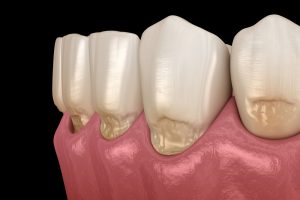飯田橋の歯医者、飯田橋サンシャイン歯科の歯ぎしり対策