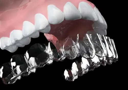 飯田橋の歯医者、飯田橋サンシャイン歯科のマウスピースよるスプリント療法